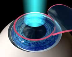 ������������ �������� LASIK